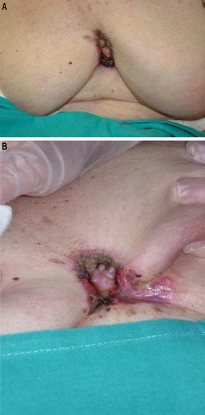 (A and B), Clinical Image. A 6 × 4 cm, infiltrated, erythematous-purple plaque in the median mammary crease, spreading to both inframammary creases and upper abdomen.