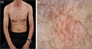 Clinicodermoscopic features of ABTM: (a), Telangiectatic erythematous macules on the chest and upper limbs. (b), Dermoscopy revealing tortuous/arborizing vessels and diffuse brownish pigmentation on the chest (×30).