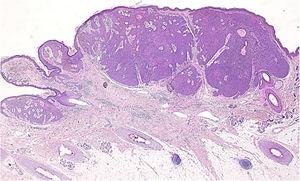 Histopathological examination of the lesion revealed a nodular tumor extending from the epidermis into the mid-dermis (Hematoxylin-eosin stain, original magnification, 20×).