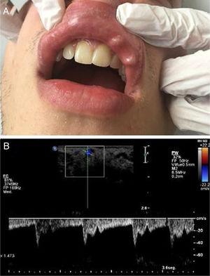 (a), Clinical photograph showing an enlarging reddish-blue, translucent, and pulsatile nodule of the right side of the lower lip of 7 mm. (b), Simultaneous spectral and color analysis using Doppler ultrasound show a high resistance forward flow in a large-diameter inferior labial artery branch at the lower lip.