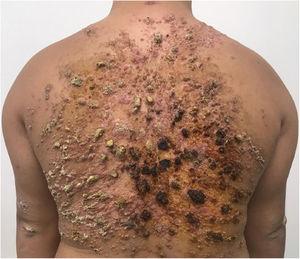 Coalescent papules forming an extensive verrucous plaque on the back, as seen in the first medical consultation.