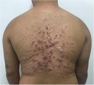 Maintenance of scarring lesions only, three months after completing treatment with miltefosine.