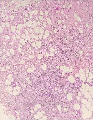 Histological section stained with Hematoxylin & eosin showing a granulomatous inflammatory infiltrate in the subcutaneous adipose tissue.