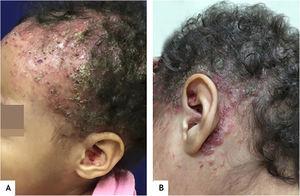 (A), Erythematous-desquamative, infiltrated lesions covered by hematic and meliceric crusts all over the scalp and the ear pinna. (B), Coalescent erythematous papules under hematic and meliceric crusts, extending from the temporal to the retroauricular region.