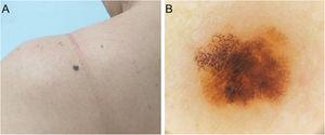 (A), In situ melanoma. Clinical diameter of 4 mm. (B), Dermoscopy shows an atypical network with irregular hyperpigmented areas.