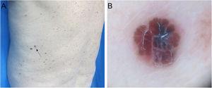 (A), Invasive melanoma of 0.75 mm in Breslow thickness with a diameter of 3 mm. (B), Dermoscopy shows a multi-component pattern with tan structureless areas, atypical blotch, shiny white structures, and serpentine vessels.