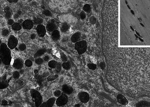 Transmission electron microscopy – detail of irregular melanosomes, inset with normal regular oval melanossomes (×50,000).