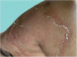 Residual lesions of pustular psoriasis.