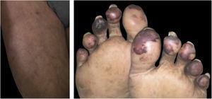 Livedo racemosa, purpura and necrosis of the extremities in a patient with COVID-19.