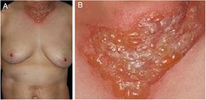 (A), Well-circumscribed, painful, infiltrative erythema with tense blisters in the V-neck area. (B), Close-up view.