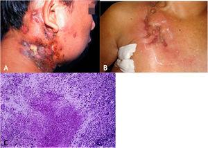 (A), Scrofuloderma – nodules/gummas and ulcerations on the cervical and right mastoid regions associated with lymph node tuberculosis. (B), Scrofuloderma – infiltrated and ulcerated lesions on the right clavicular region. (C), Scrofuloderma – caseation necrosis surrounded by granulomatous inflammation with a palisade of macrophages and Langhans-type multinucleated giant cells, (Hematoxylin & eosin, ×40).