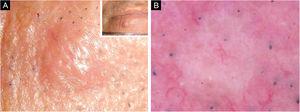 (A), A skin-colored, firm, non-tender papule with a diameter of 4 × 5 mm. (B), Whitish-pinkish homogenous structureless area on dermoscopy.