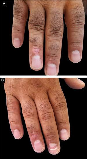 (A), A male patient with vitiliginous patches in the acral area. (B), Treatment result with excellent outcome after 18 months.