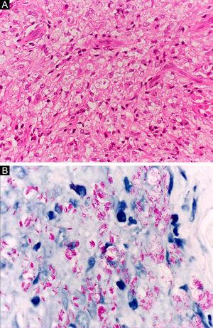 Lepromatous leprosy. (A), Dense dermal cell infiltrate consisting of macrophages with vacuolated cytoplasm (Hematoxylin & eosin, ×400). (B), Numerous isolated acid-fast bacilli forming globi (Faraco, ×1000).