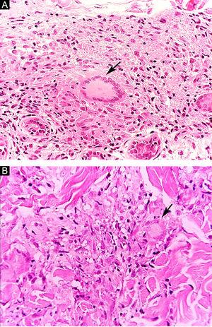 Tuberculoid leprosy. (A), Epithelioid granuloma with Langhans-type multinucleated giant cell (arrow). Borderline leprosy (B), Loose granulomatous arrangement with the presence of a multinucleated giant cell with fine cytoplasmic vacuolization (arrow). (Hematoxylin & eosin, ×400).
