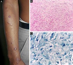Histoid leprosy. (A), Well-delimited erythematous-ferruginous papules disseminated throughout the upper limb. (B), Proliferation of spindle-shaped macrophages with finely vacuolated cytoplasm (Hematoxylin-eosin, ×200). (C), Alcohol-acid resistant bacilli in the cytoplasm of spindle-shaped macrophages. (Faraco, ×1000).