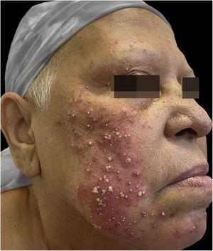 Presence of pustules on an erythematous base, symmetrically distributed on the face.