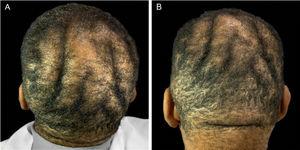 (A and B) Clinical aspect of the scalp.
