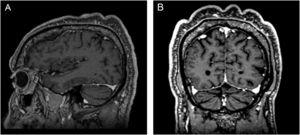 Magnetic resonance imaging of the skull. (A), Sagittal section. (B), Coronal section, showing skin undulations.