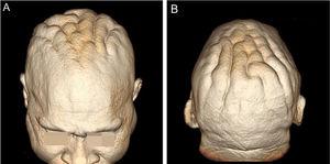 (A and B), Three-dimensional (3D) reconstruction of the cerebriform skin from the magnetic resonance imaging of the cephalic segment.