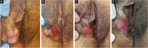 Patient with hypertrophic chronic mucocutaneous herpes tumor. A, Pre-treatment. B, In the immediate postoperative period after surgical removal of the tumor lesion. C, After 4 weeks of surgical excision, with the surgical wound undergoing healing. D, After 10 weeks of the procedure, with the healed lesion.