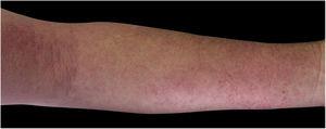 Eczema on the upper limb due to allergic contact dermatitis to corticosteroid.