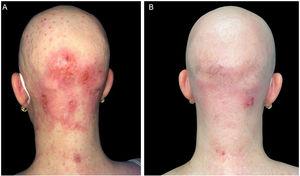 (A), The patient with severe AD, alopecia areata and molluscum contagiosum infection before treatment with dupilumab. Excoriation, eczematous lesions, and dome-shaped papules with central umbilication widespread all over the body but especially on her face and scalp. (B), Two months after starting treatment with dupilumab. Clinical remission of atopic dermatitis and resolution of molluscum contagiosum infection.