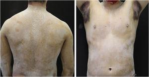 Minor's test demonstrating preserved sweating only in the axillary region after strenuous physical activity.