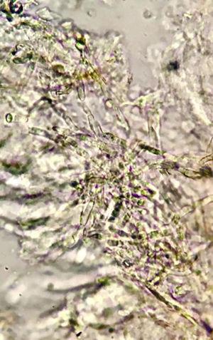 Septate hyaline hyphae with branching at an acute angle. Direct examination, KOH 20%, ×40.