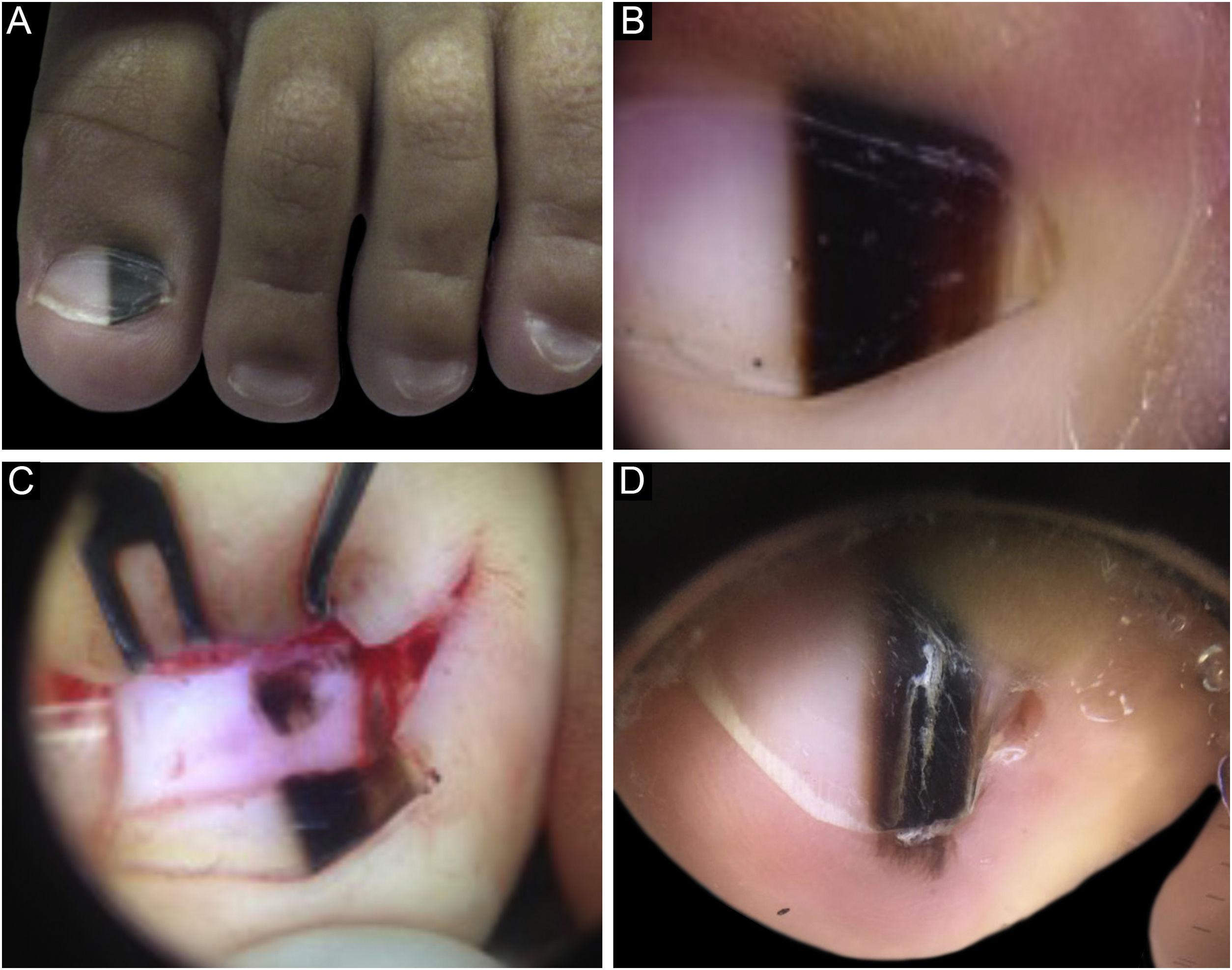 Non‐melanoma Hutchinson's sign: a reappraisal of this important, remarkable  melanoma simulant - Baran - 2018 - Journal of the European Academy of  Dermatology and Venereology - Wiley Online Library