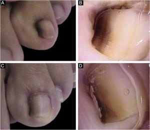 Clinical (A) and dermoscopic (B) aspect at the first consultation; (C–D) Clinical (C) and dermoscopic (D) aspect five years after the biopsy.