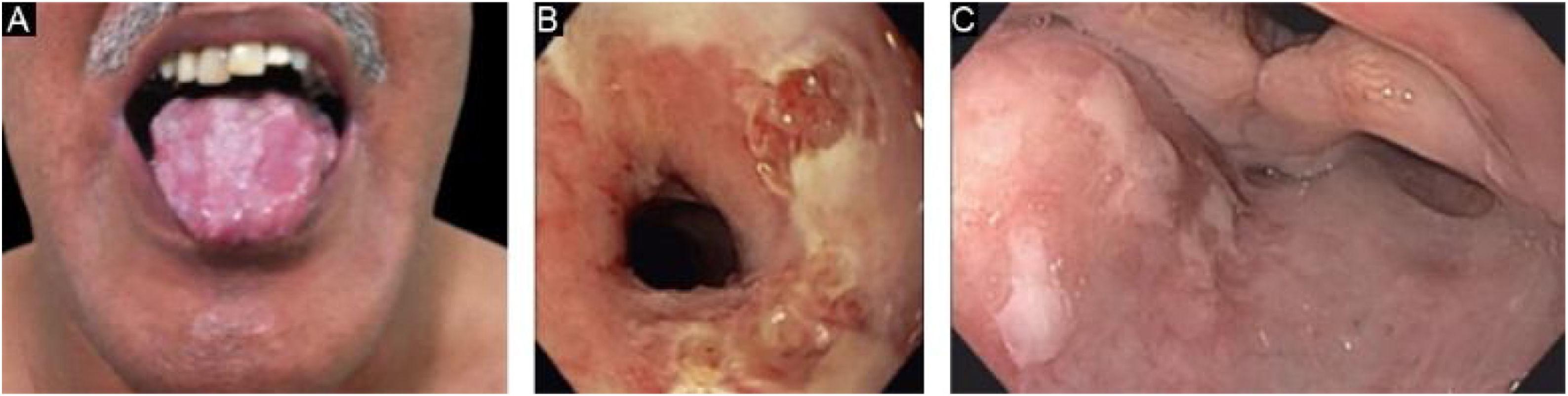 epidermolysis bullosa oral