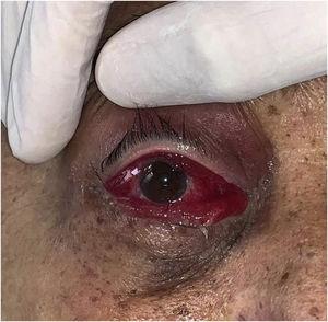 Erythema and severe swelling of the conjunctiva associated with upper eyelid erythema. Rhino-orbito-cerebral mucormycosis.