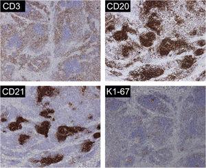Immunohistochemistry of CD3, CD20, CD21, Ki67 (about 15%) were positive (original magnification ×40).