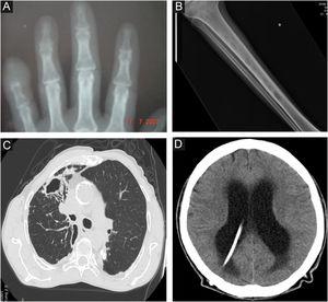 Radiological images in human sporotrichosis. (A) Osteoarticular form – resorption of the distal phalanx of the little finger caused by a cat bite (plain radiography). (B) Systemic form with osteoarticular manifestation – osteolytic lesions in the tibial medulla by hematogenous spread in a patient with systemic sporotrichosis and AIDS (plain radiography). (C) Pulmonary – cavity in the upper lobe of the right lung and extensive pulmonary opacity with a fibroretractile appearance (computed tomography). (D) Neurosporotrichosis – meningitis in a patient with systemic sporotrichosis and AIDS. Increase in the dimensions of the ventricular system, mainly in the supratentorial region (tetraventricular hydrocephalus), ventriculoperitoneal shunt catheter (computed tomography).
