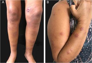 Immunoreactive forms of human sporotrichosis. (A) Erythema nodosum in the lower limbs (specific sporotrichosis lesion near the knee). (B) Sweet syndrome.