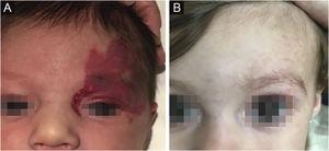 (A) Pre-treatment initiation at 3 weeks old. (B) Post-treatment, at 12 months old (patient # 50).