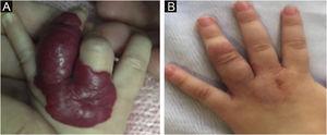 (A) Pre-treatment initiation at 8 weeks old. (B) Post-treatment, at 20 months old (Patient #98).