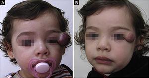 (A) Started treatment at 9 months old. (B) Poor response at 20 months old, when propranolol was stopped. Required surgical management (Patient #1).