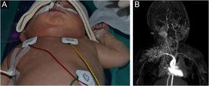 Clinical and radiological images of kaposiform hemangioendothelioma (KHE). (A) Clinical image at presentation: vascular-like lesion located at his right cervical area and chest. (B) Radiological image of a vascular tumor compatible with HEK with deep endocervical extension.