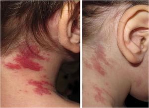 Clinical images of tufted angioma (TA) lesions. (A) Violaceous macules and plaques on the right lateral aspect of the neck at the age of two; first presentation of TA when discontinuation of aspirin and ticlopidine. (B) Partial clearance after reintroduction of aspirin in monotherapy.