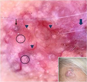 Pink shiny nodule on the right forehead (inset), polarized dermoscopy showed blue/gray-white veil (thin black arrow), bright-white clods and dots resembling rosettes (circles), arborizing vessels (arrowheads) and white shiny streaks (thick arrow).