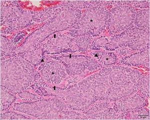 Jigsaw puzzle-like arrangement of islands of cells surrounded incompletely by eosinophilic basement membrane-like material (arrows). Peripheral basophilic palisading cells (arrowheads) with centrally located paler elements (asterisks) (Hematoxylin & eosin, ×200).