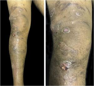 Erythematous-violaceous nodules, some of them ulcerated, in the right lower limb.
