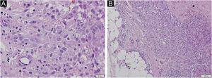 Histopathology of the nodular lesion (Hematoxylin & eosin): epithelioid cells with mild atypia and granulomatous arrangement (A, B). Dermo-hypodermic infiltrate and focal areas of necrosis (*) in the deep dermis (B).