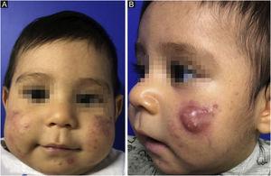 Infantile acne. (A) At two months of age, papules, pustules, and comedones on the face; (B) At seven months, even with the implemented therapy, the patient had a draining cyst, scars, and active papulopustular lesions.