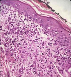 Chronic dermatitis associated with the presence of cells suggestive of Langerhans cells (Hematoxylin & eosin 100X).