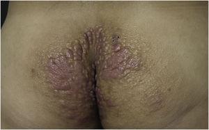 Erythematous, confluent plaques with an infiltrated appearance, in the gluteal region, bilaterally.