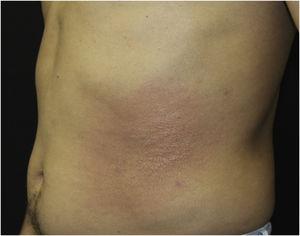 Erythematous plaque with a papular center on the left abdominal region.