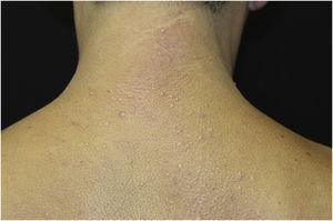 Erythematous, whitish papules on the upper back and posterior cervical regions.